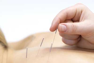 acupuntura acupuntura